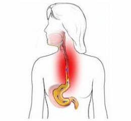 Боль в пищеводе из-за отравления каустической содой